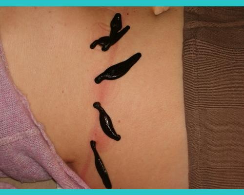 Sangsues sur cicatrice