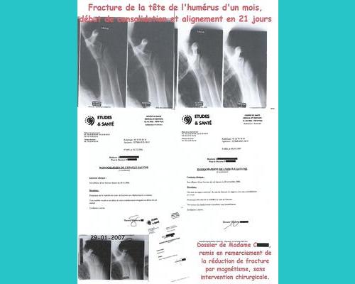 réduction de fracture de l'humérus par magnétisme