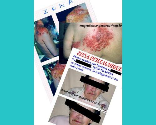 Témoignages de "coupe feu" de zona (2000, 2005, 2006)