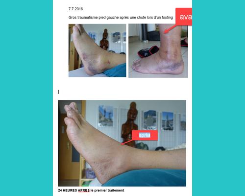 traitement Miltathérapie, exemple d'évolution en à peine 24 herues