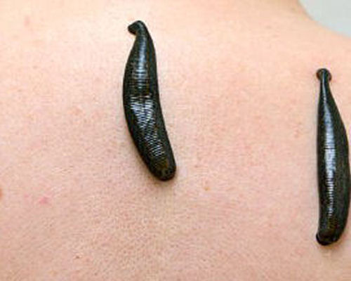 Hirudothérapie (sangsues)