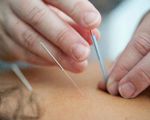 Acupuncture